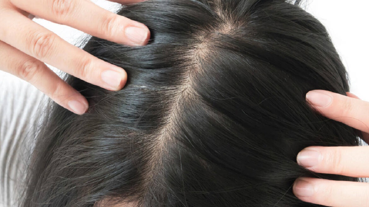 Ankara Saç Dökülmesi Tedavisinde Sevilen Lokasyonlar Arasında Yer Alıyor